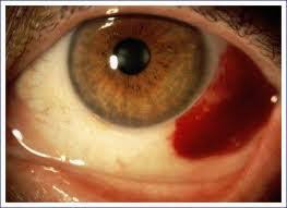 Medi-Mere - Huisartsenpraktijk In Almere: Bloeduitstorting Oogwit