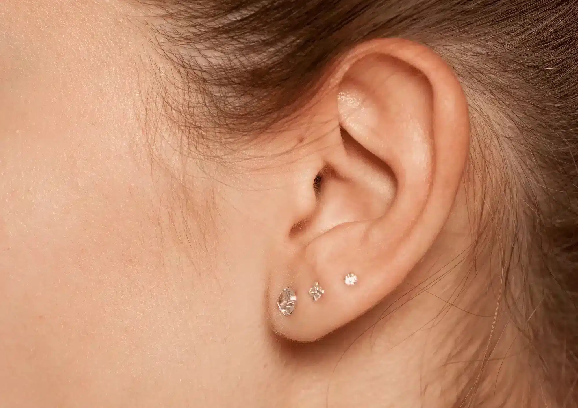 Repairing Split Earlobes and Enlarged Piercing Holes