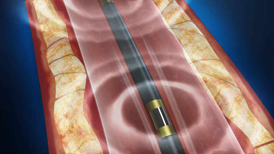 Shockwave Lithoplasty for Peripheral Artery Disease Medical