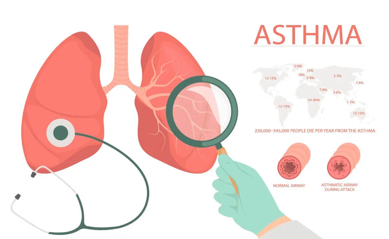 Asthma Its Types and Medications Free 2023