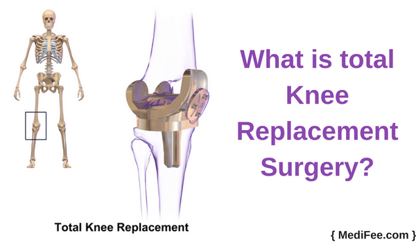12 Common Knee Replacement Surgery Questions