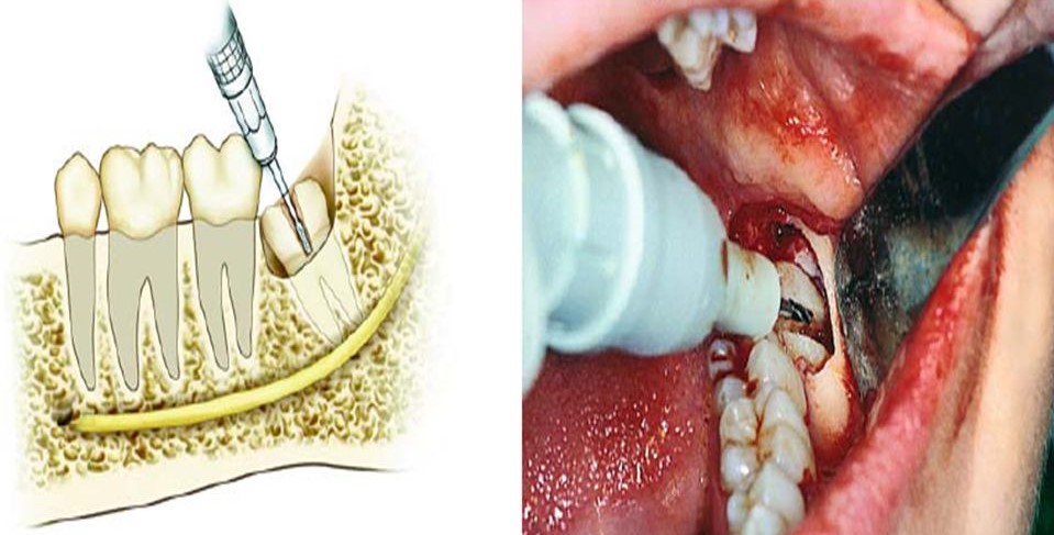 Wisdom tooth pain know the best Advice by Dentist