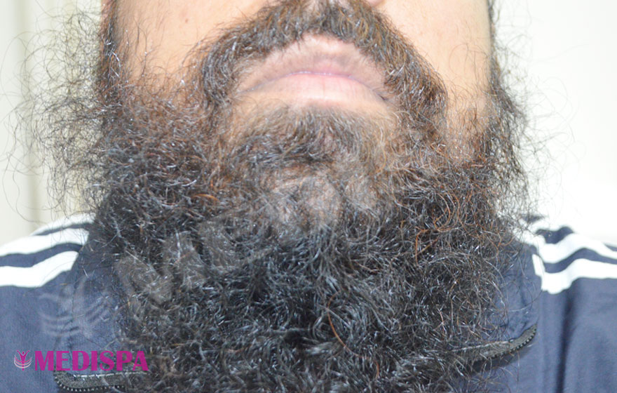 Beard Hair Transplant Results Photo Gallery Top Hair Transplant