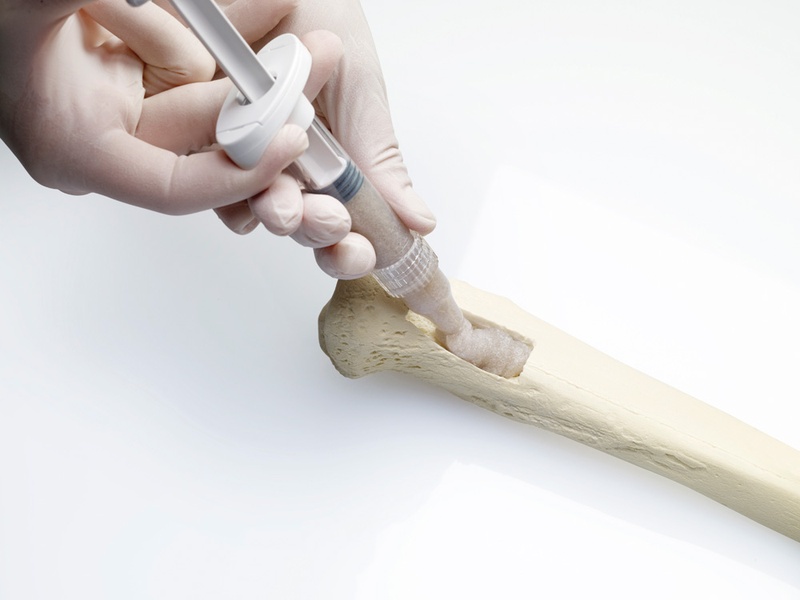 Bone putty bone graft