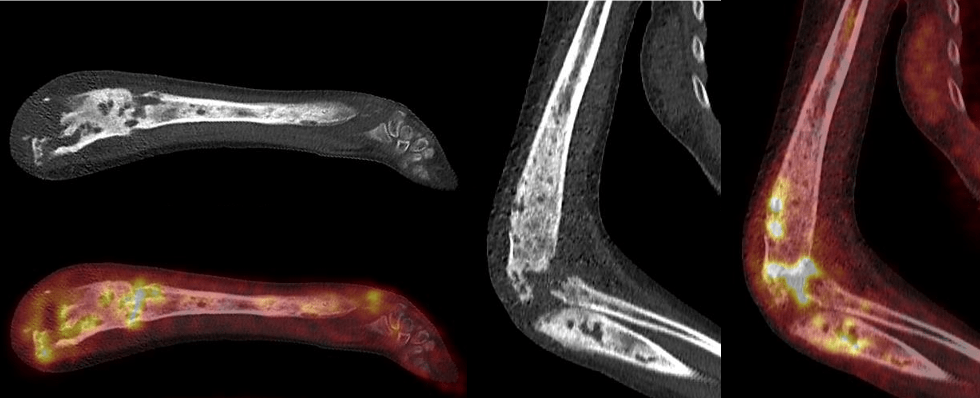 Ostéo arthrite tuberculeuse