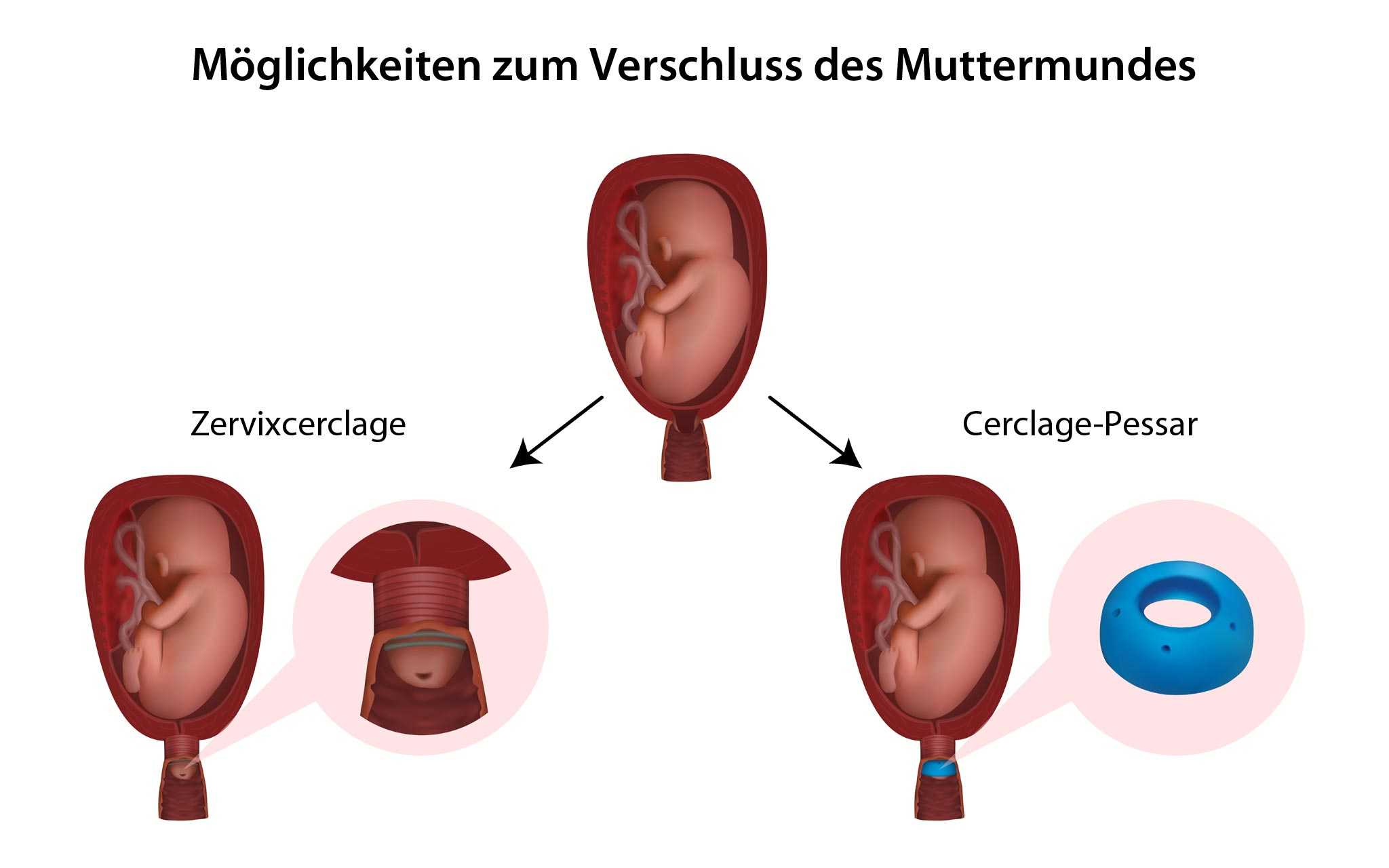 Cerclage Muttermund offen in der Schwangerschaft Muttermundverschluss