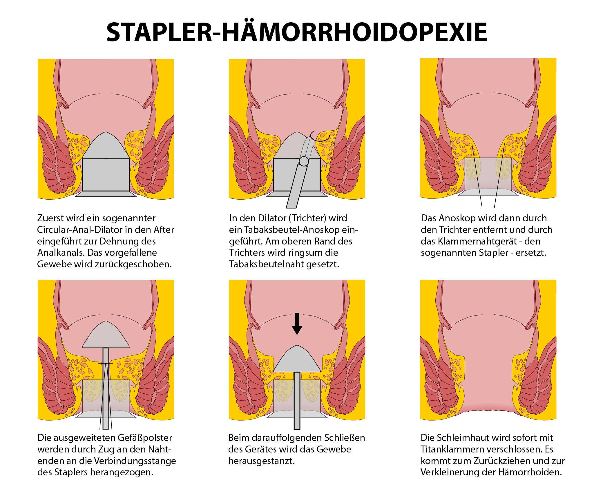 Wie Sehen Hämorrhoiden Aus Bilder Captions Ideas