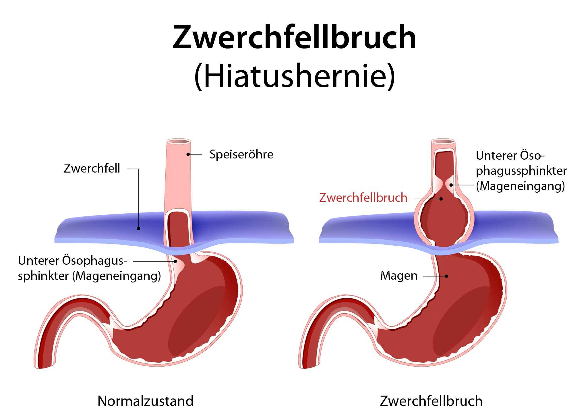 Zwerchfellhernie Zwerchfellbruch Operation Bruch Hernie