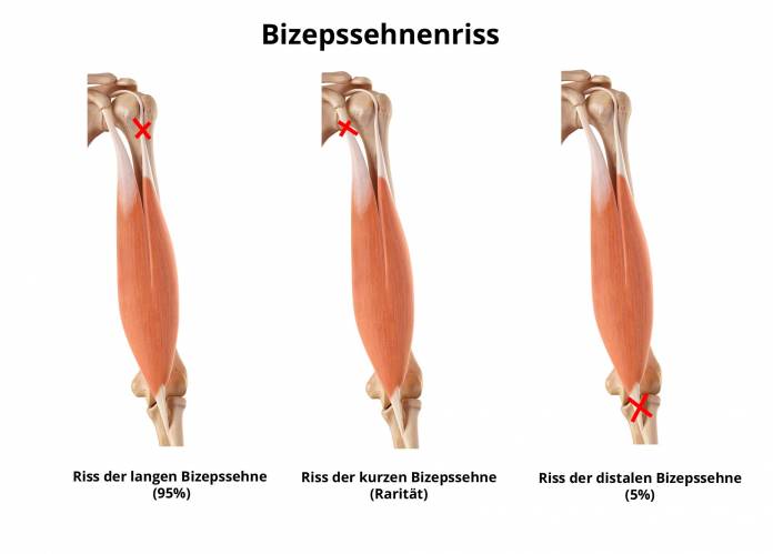 Bizepssehnenriss (Riss der Bizepssehne) » richtig behandeln