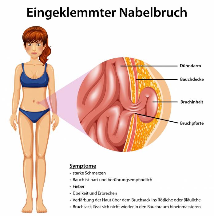 Wie gefährlich ist ein Nabelbruch?