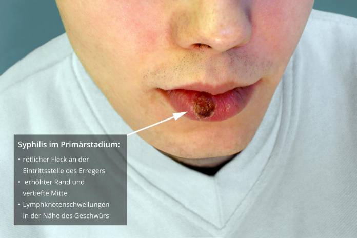 Welche Symptome treten bei Syphilis auf?