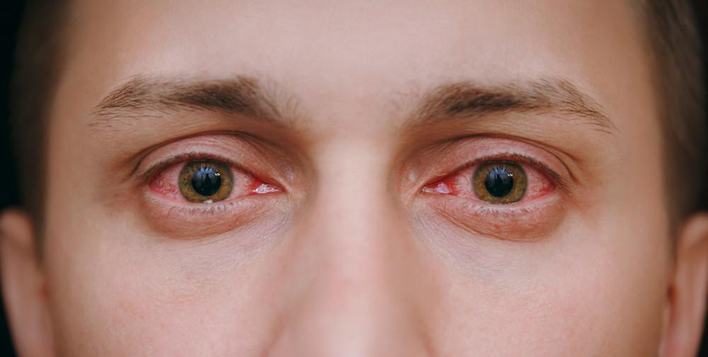 Bloodshot Eyes Should you be worry