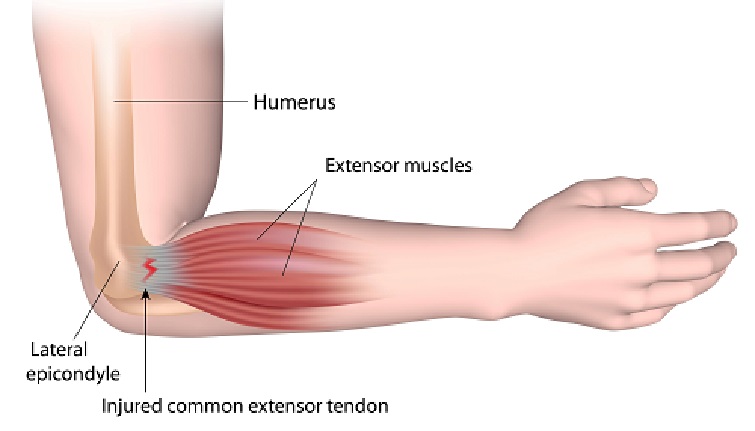 Tennis Elbow Medsearch Limited