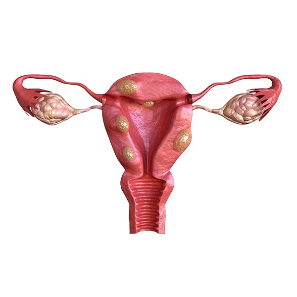 Embolization to Treat Uterine Fibroids with Bleeding and Severe Anemia