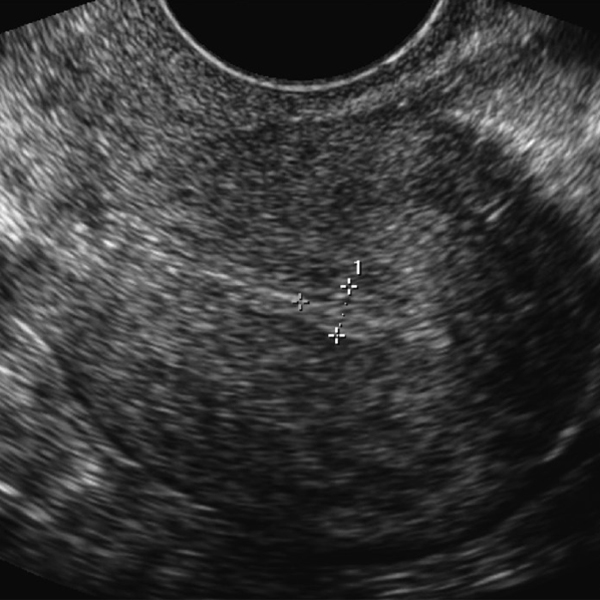 Frozen Embryo Transfer in Mildly Stimulated Cycles with Letrozole