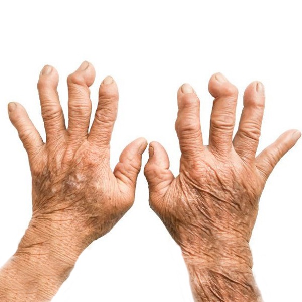 सोरियाटिक गठिया के बारे में सब जाने Psoriatic Arthritis in Hindi