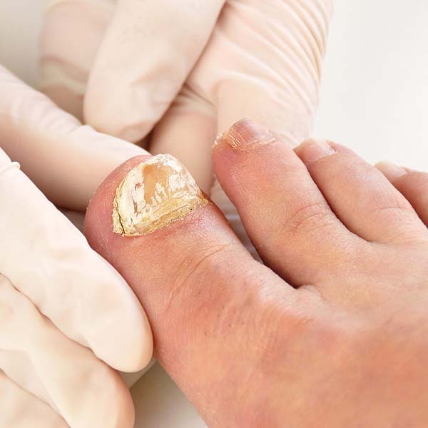 नाखूनों में कवक के लक्षण, कारण, इलाज, दवा, उपचार और परहेज Nail Fungus