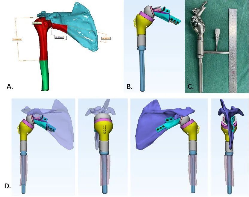 News Case Study Sharing 3D Printed Osteotomy Guide and Personalized Prosthesis for Reverse