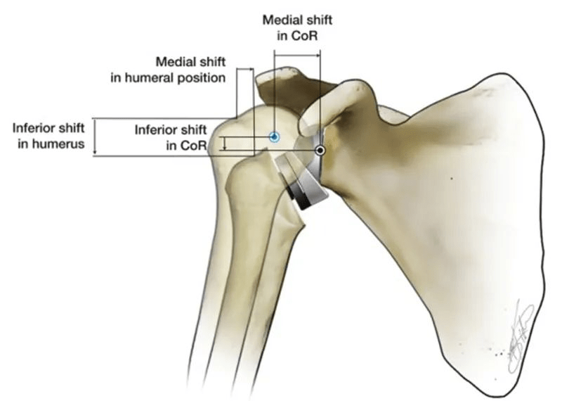News The History of Shoulder Replacement
