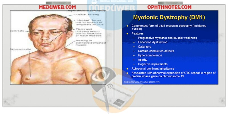 Myotonic dystrophy capsule Meduweb