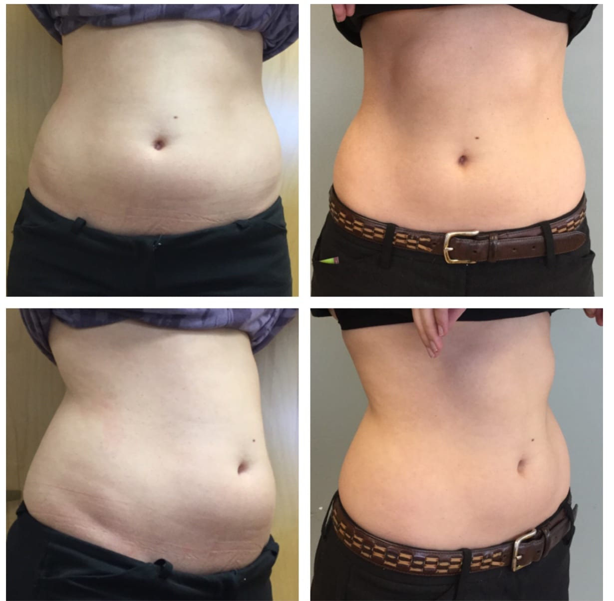 Ultrashape Power in Silver Spring W Med Spa Cosmetic DermatologyW