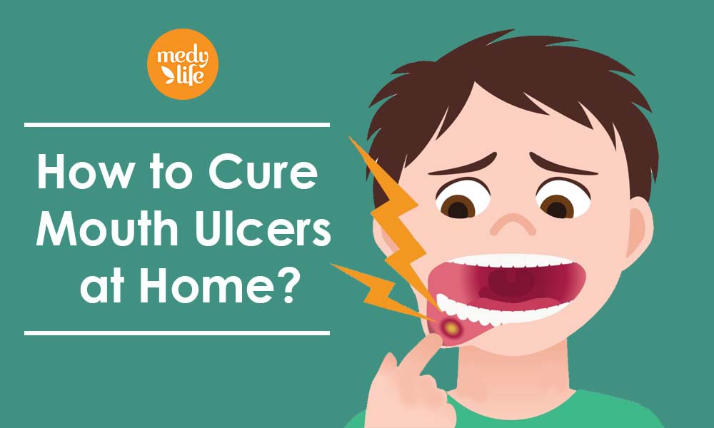 How to Cure Mouth Ulcers at Home? Medy Life