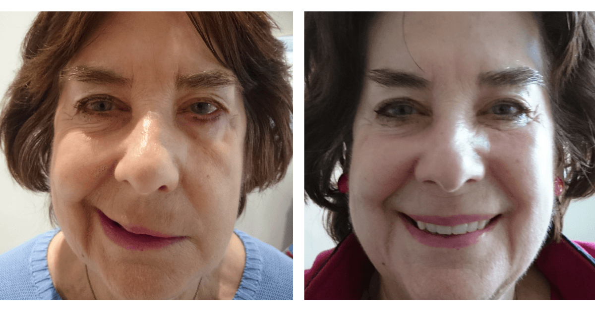Jun 11, 2021 · cancer campaigner vicky phelan has revealed that she has developed bell's palsy as a side effect of the experimental treatment she is undergoing in the us. CACI for Bell's palsy | Melior Clinics