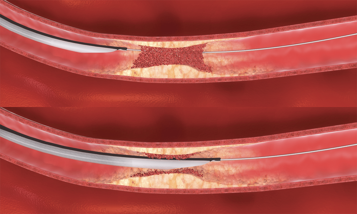 ASAP® & ASAPLP Aspiration Catheters Merit Medical