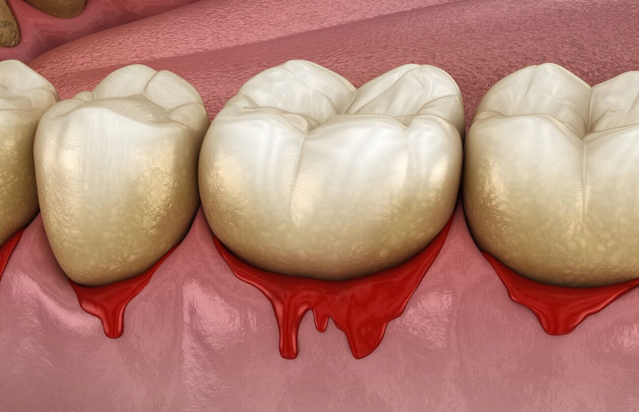 Do Not Ignore Bleeding Gums Laser Dentistry in East Hanover, NJ