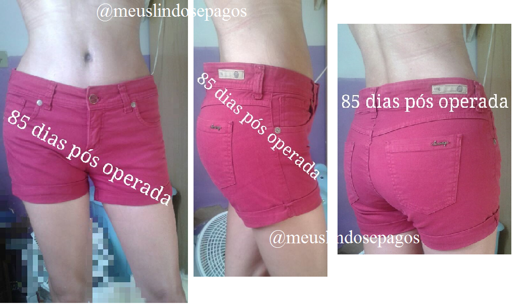 Meus, Lindos e Pagos! » Arquivos » Abdominoplastia com Lipoescultura + enxerto de gordura nos