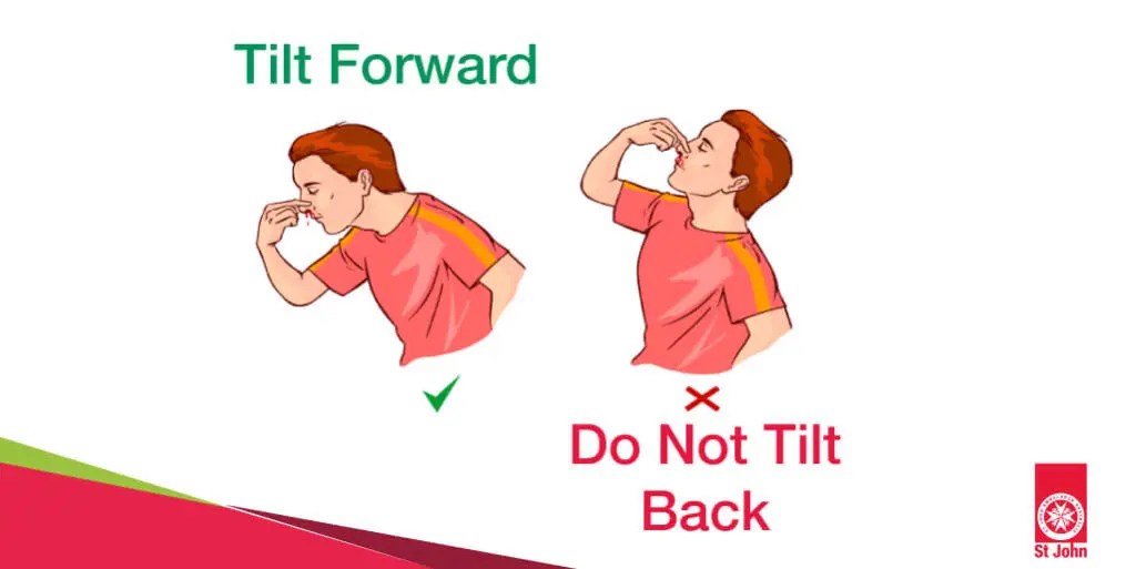 A Comprehensive Guide to First Aid For Nosebleed Medlink Healthcare Group