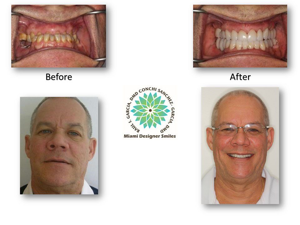 Smile Makeover Miami Coral Gables