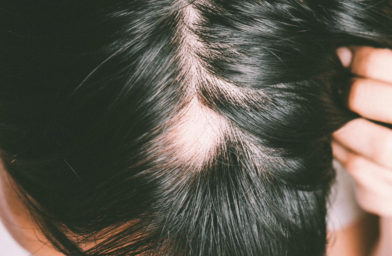 Alopecia Areata What You Need to Know Miami Hair Institute