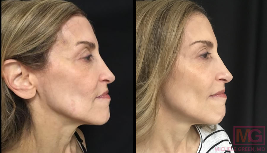 Sculptra Injections for Fillers, Face, Butt & Body