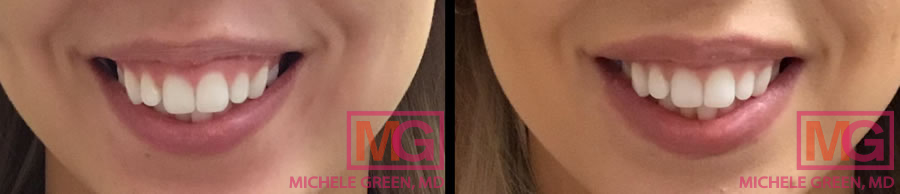 What is the Botox Lip Flip Procedure? Dr. Michele Green M.D.