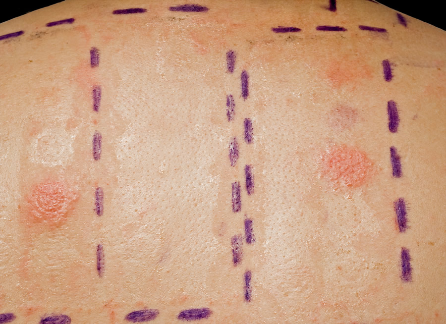Skin Allergy Patch Testing & T.R.U.E. Tests NYC