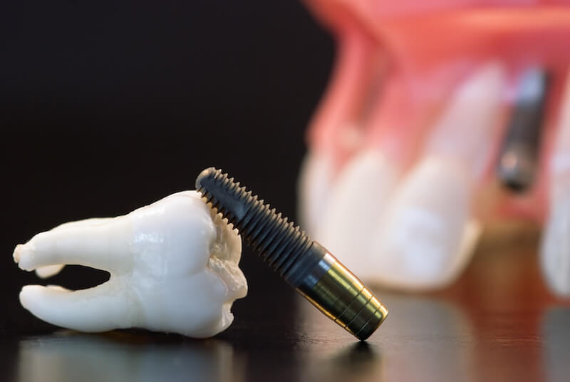 Should I Choose Dental Implants? Michelle Wang DDS