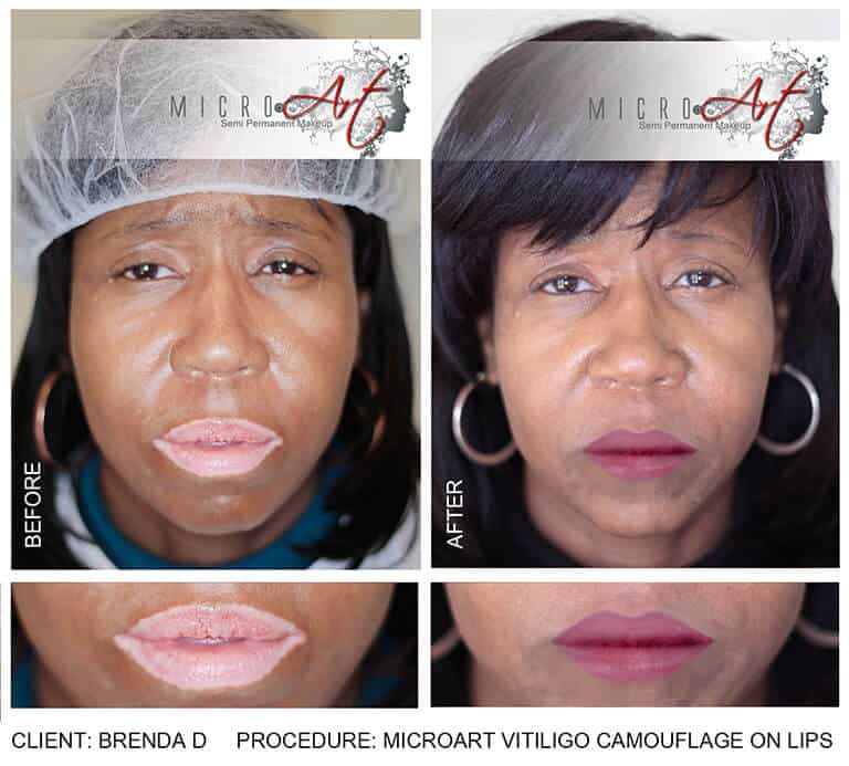 Vitiligo Treatment By MicroArt Semi Permanent Makeup