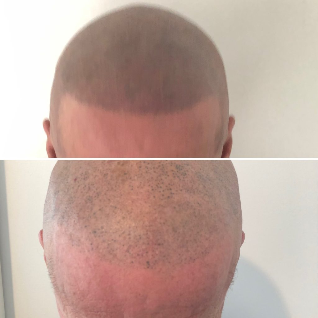 Scalp Micropigmentation Certification Design Talk