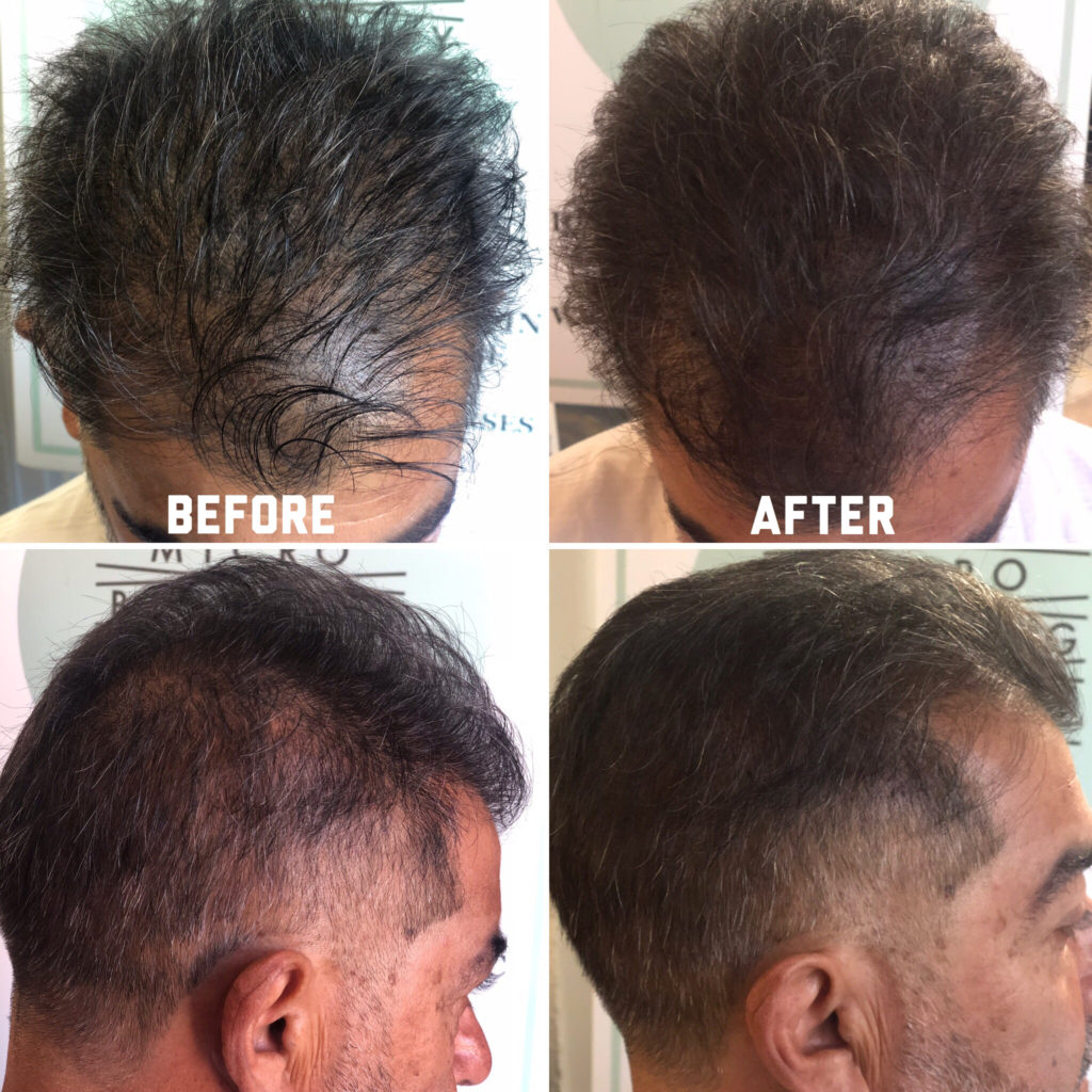 Scalp Micropigmentation Training Course California, Ventura County