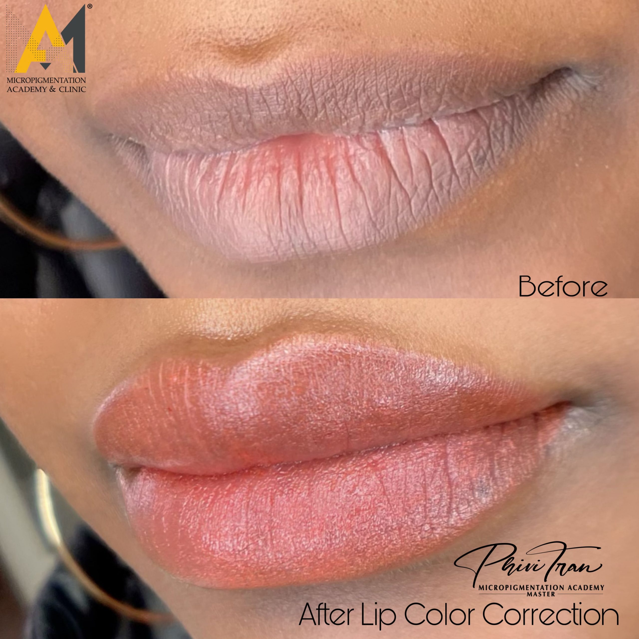 Best Permanent Lip Contour Treatment Wethersfiled, CT