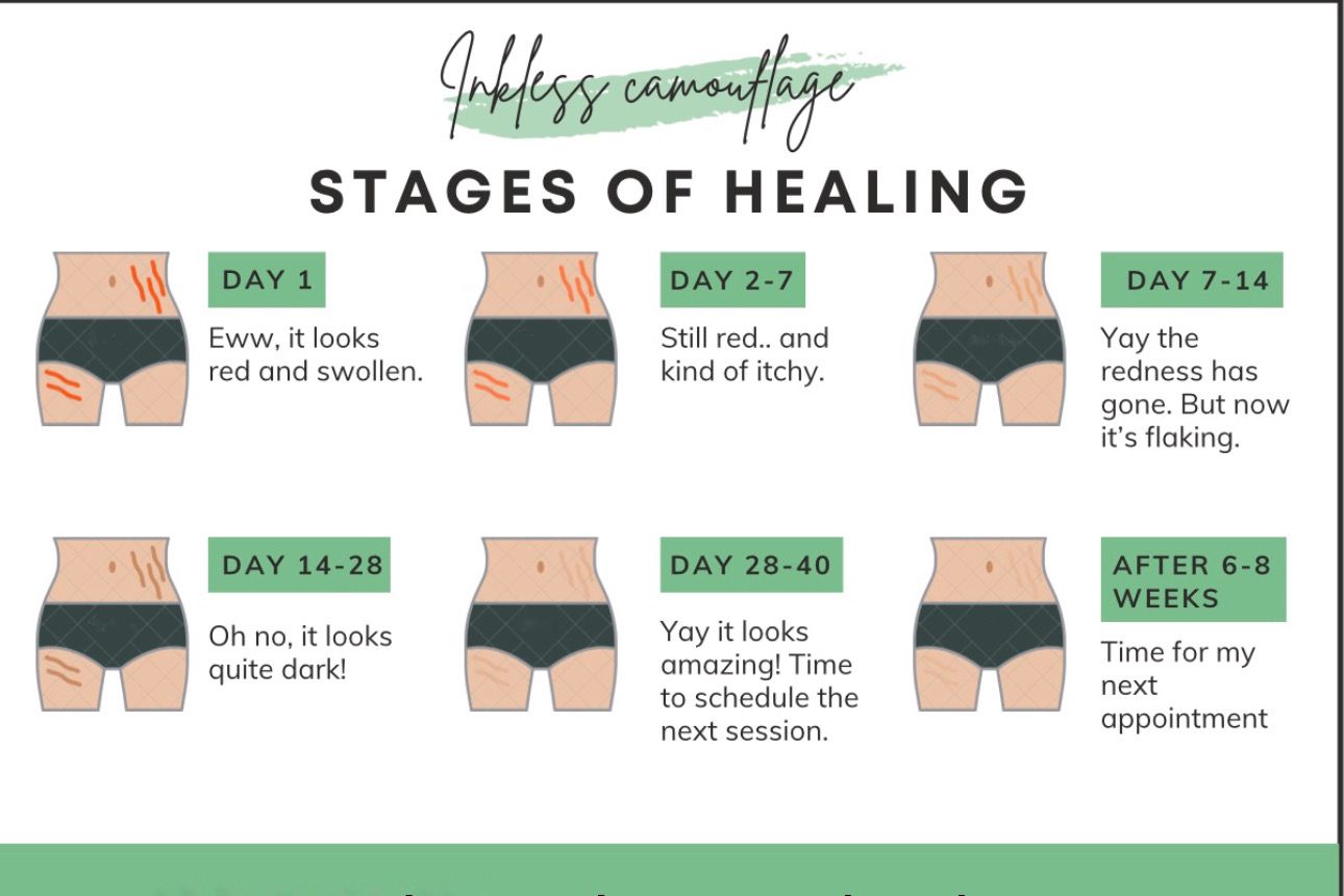 Inkless Stretch Mark Revision Micropigmentation Center of Miami