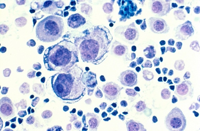Observing Cancer Cells Under The Microscope » Microscope Club