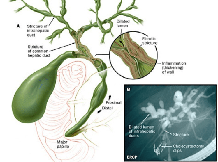 Cirrosis Biliar Primaria Mi Endoscopia