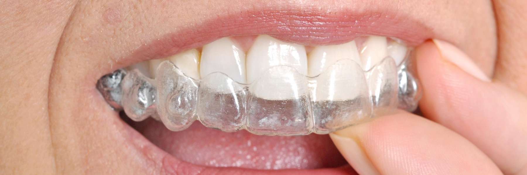 How Does Invisalign Work? Invisible Braces Phoenix, AZ