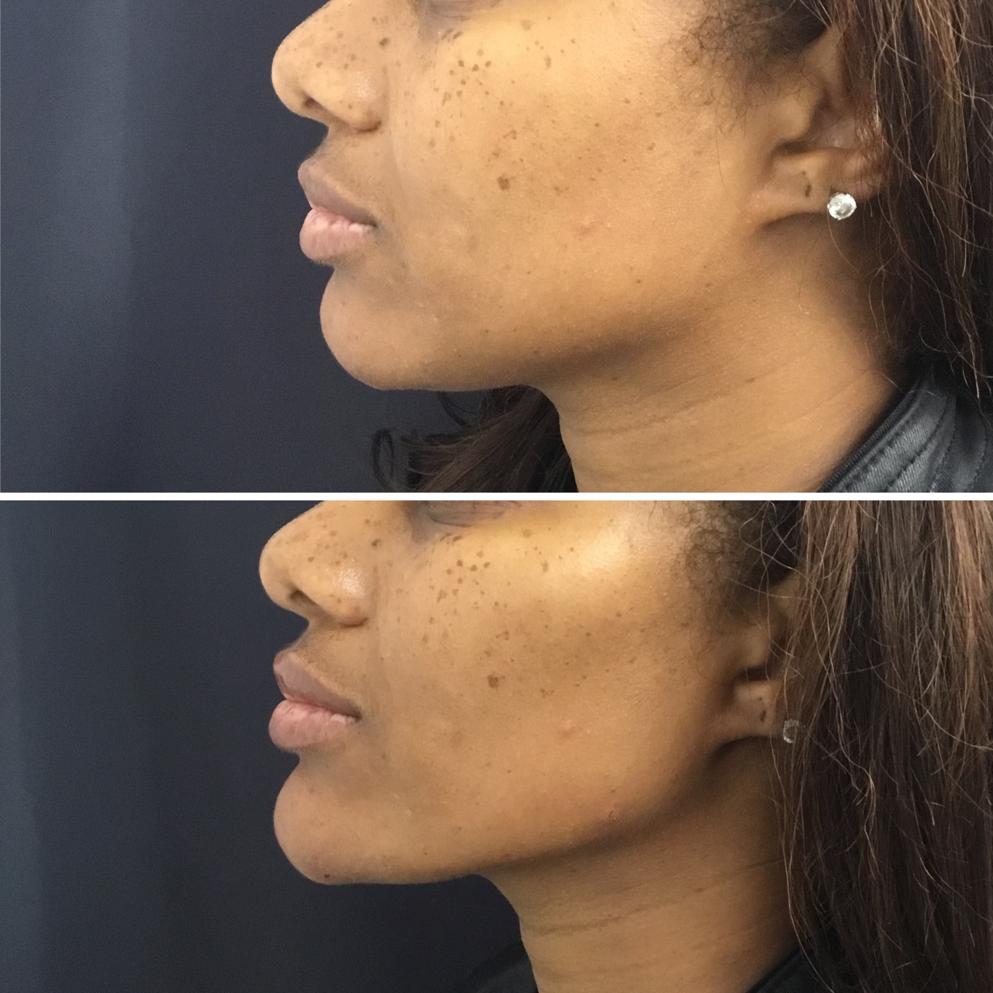 Jawline Filler in Vienna Virginia Milani MedSpa