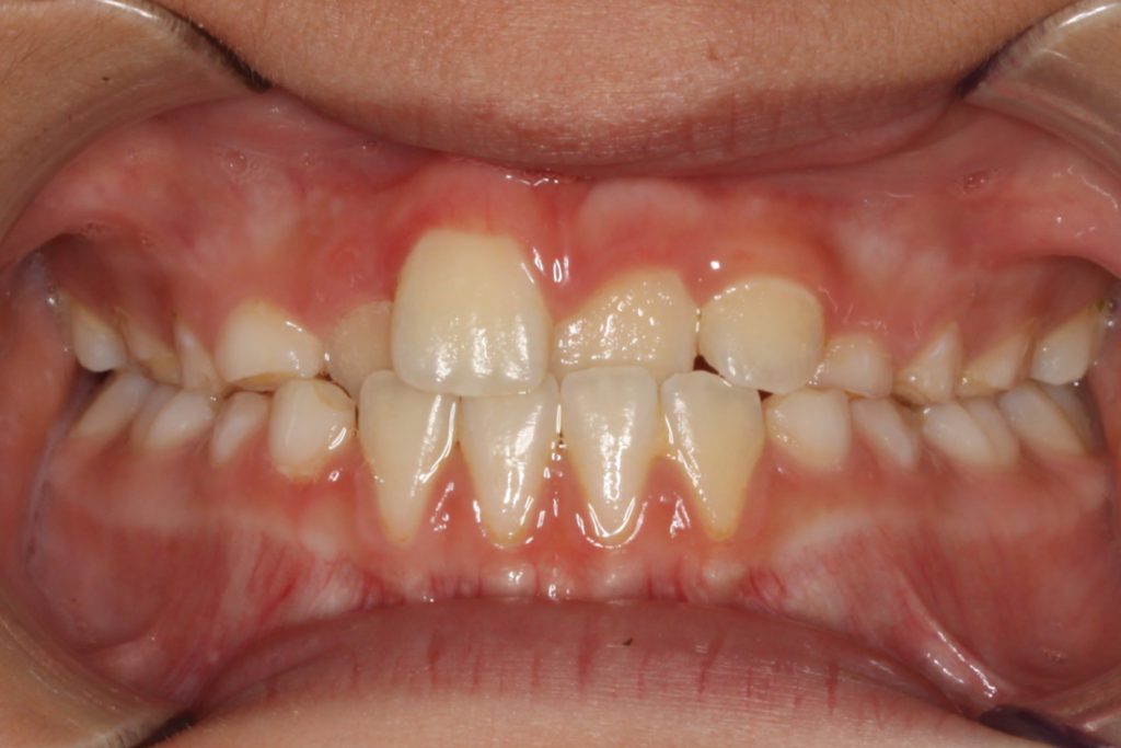 Before & After Orthodontic Photos Somerville NJ Palate Expanders