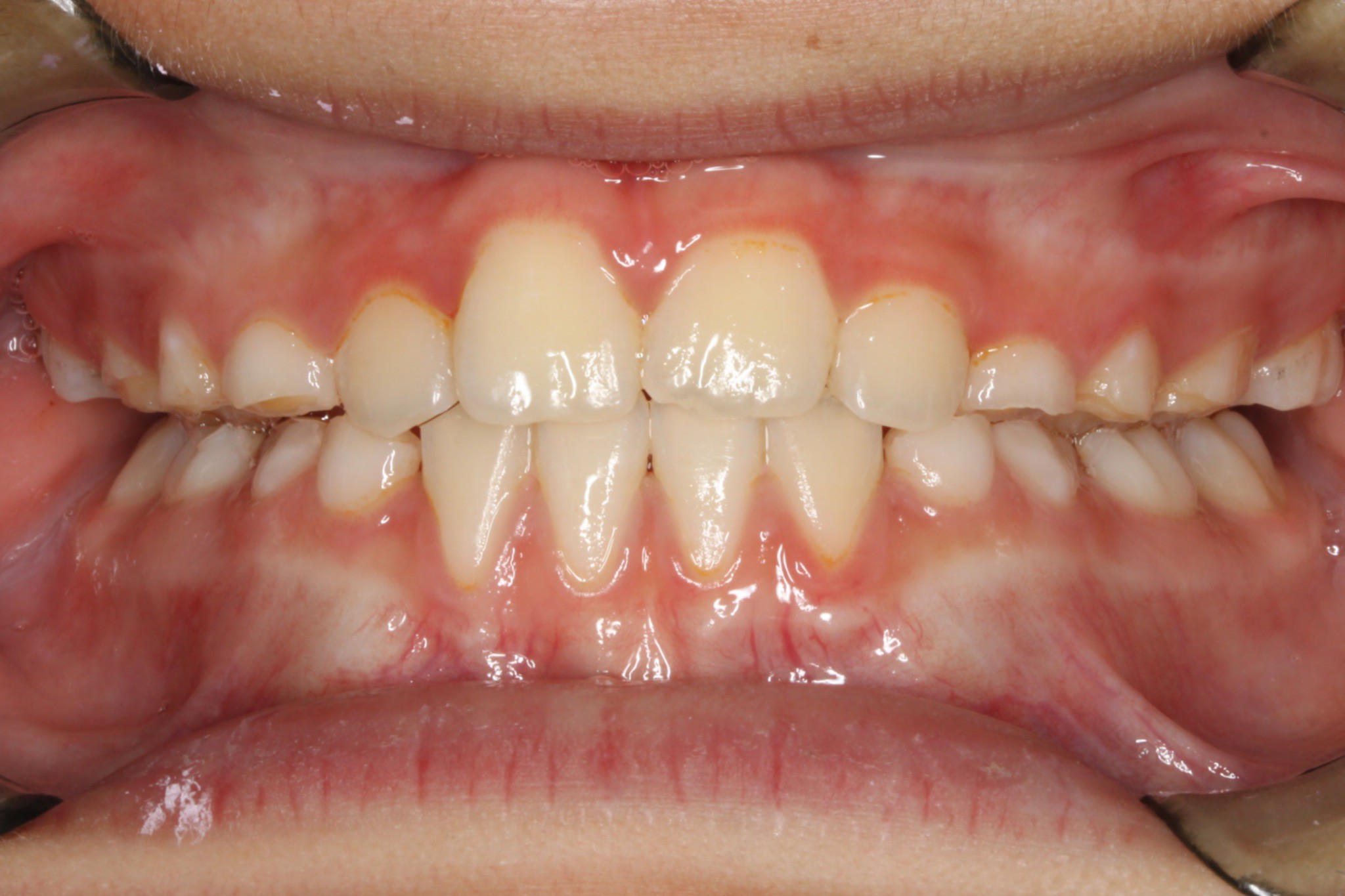 Before & After Orthodontic Photos Somerville NJ Palate Expanders