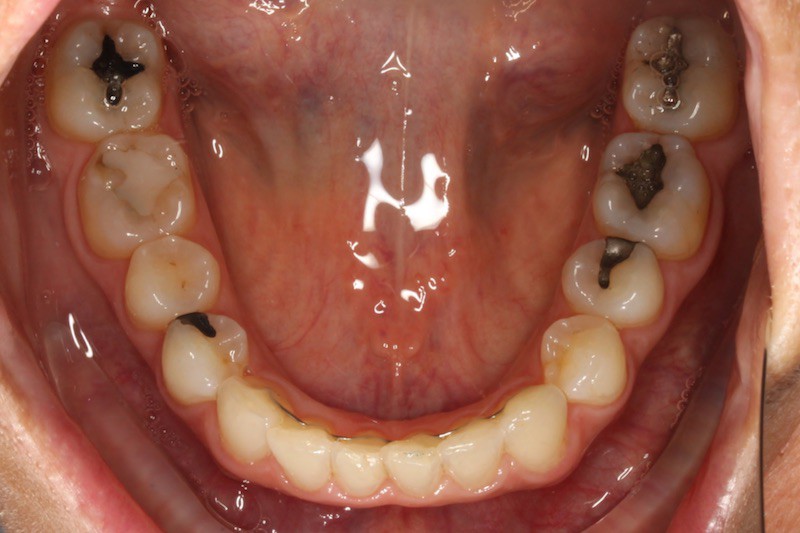Before & After Orthodontic Photos Somerville NJ Invisalign Corrections