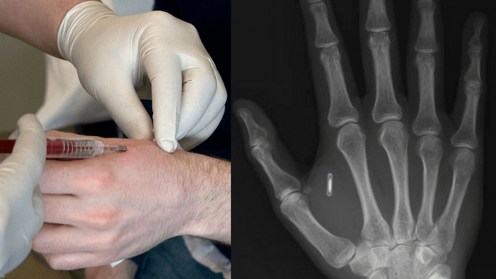 Wisconsin Company is Injecting RFID Microchips Into Hands of Employees